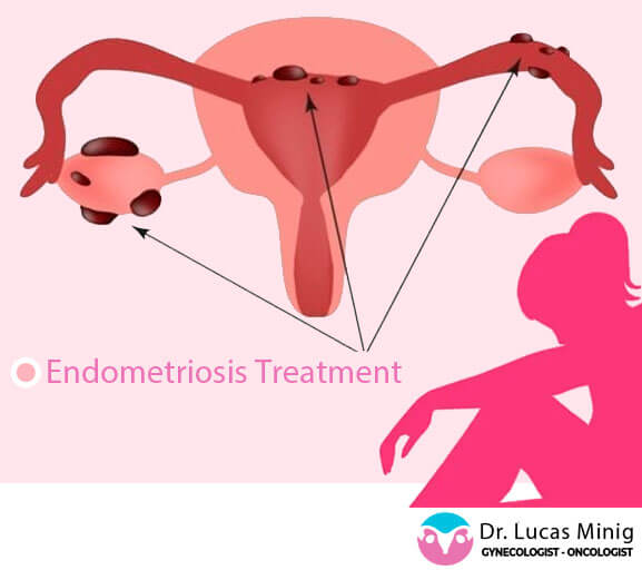 Endometriosis Treatment in Spain Europe