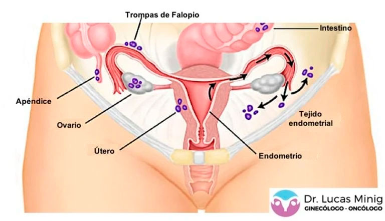 Endometriosis-varcelona