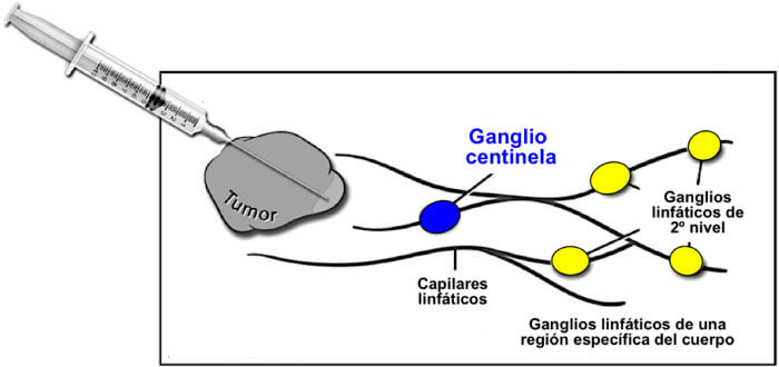 Ganglio Centinela