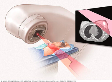 Radioterapia adyuvante tratamiento cáncer de mama.