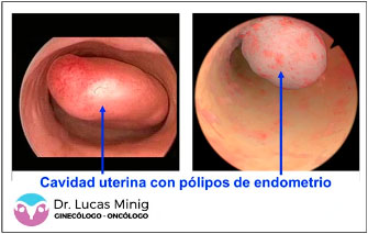 Cavidad Uterina con Pólipos Endometrio