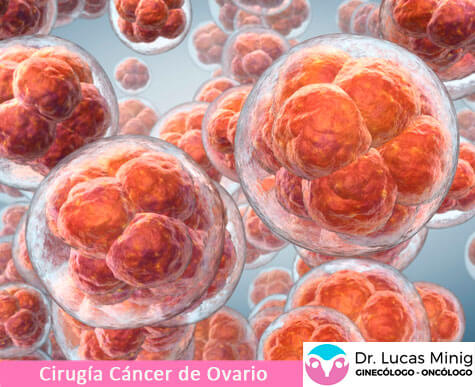 Ovarian Cancer Surgery Spain Specialist in Ovarian Disease in Spain and Europe. Lucas Minig