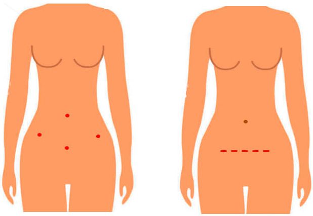 A diagram showing the 4 small keyhole incisions compared to the longer incision made during a traditional "open" surgery