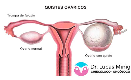 Cirugía Quistes Ovarios
