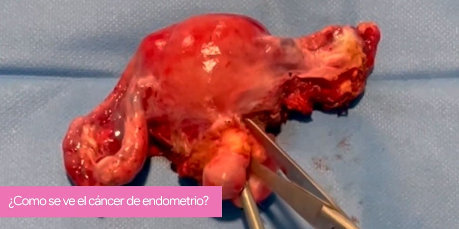 What does endometrial cancer look like?