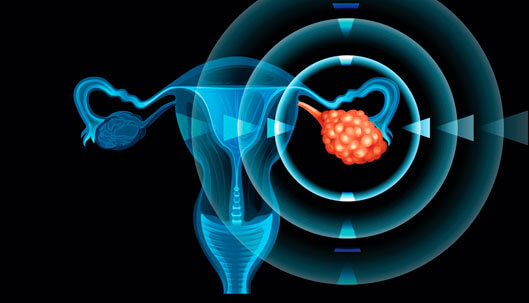 Gynecological Ovarian Cancer