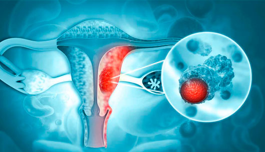 Gynecological Uterine Cancer