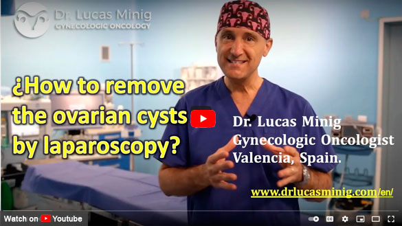 How to remove the ovarian cysts laparoscopy. Spain. Lucas Minig