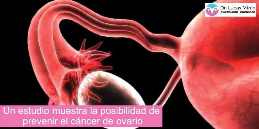 [:es]Investigan cómo prevenir el cáncer de ovario. Doctor Lucas Minig[:]