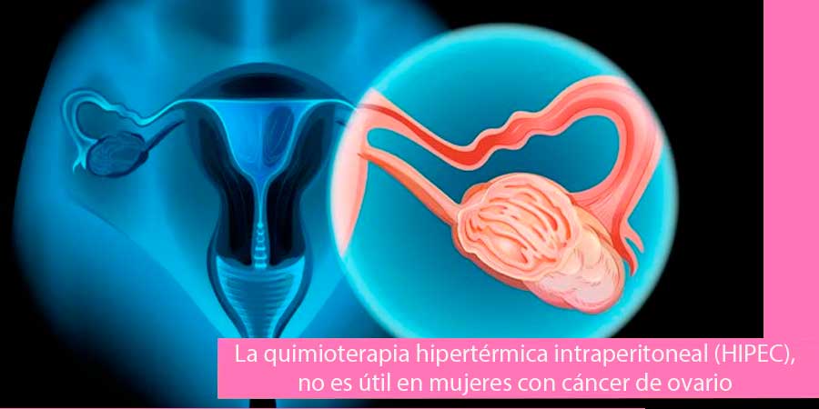 [:es]La quimioterapia hipertérmica intraperitoneal (HIPEC), no es útil en mujeres con cáncer de ovario[:]