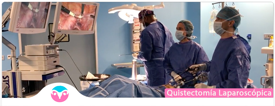 Quistectomía Laparoscopica Cáncer Ovarios Dr Lucas Minig