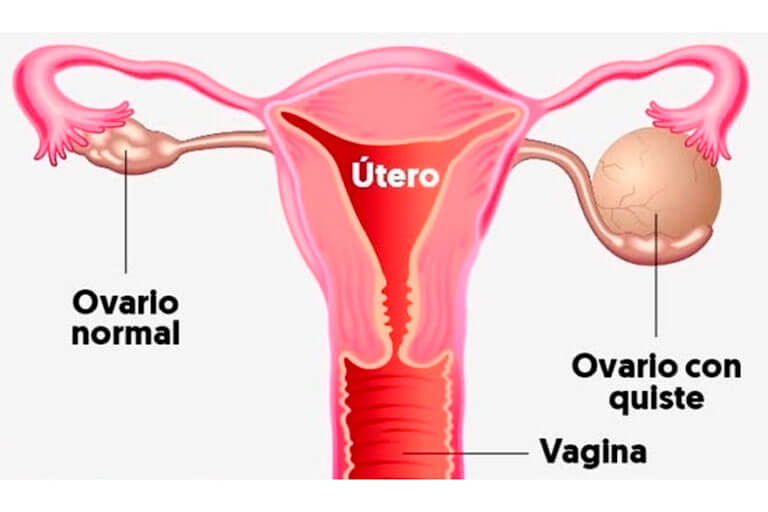 Ovarian Cysts In Valencia