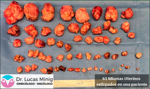 Miomas Foto real 63 miomas uterinos extirpados a una paciente. Dr Lucas Minig Ginecólogo Experto en Miomas del Utero