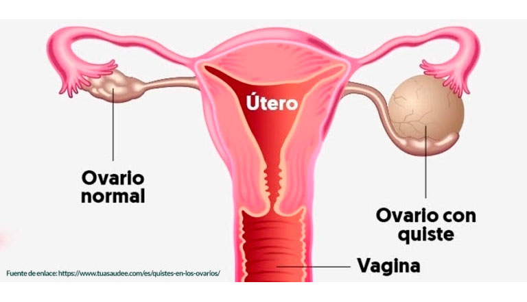 Cáncer de ovario: MedlinePlus en español