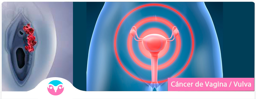 Después del diagnóstico de cáncer de vulva, se hacen pruebas