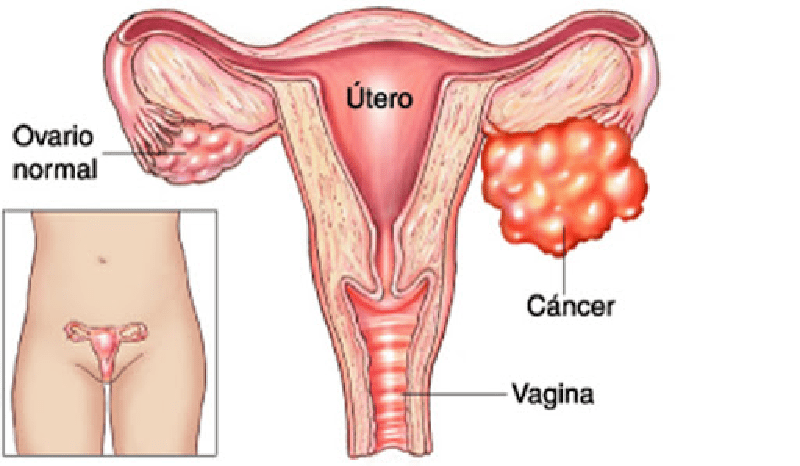 [:es]Etapa avanzada de cáncer de ovario[:]