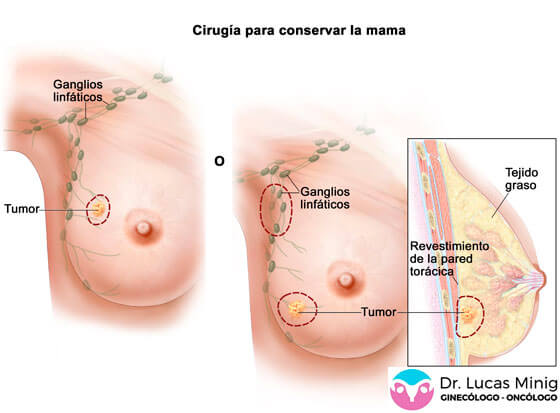 Cirugia Conservar la mama Tumorectomia Dr. Lucas Minig