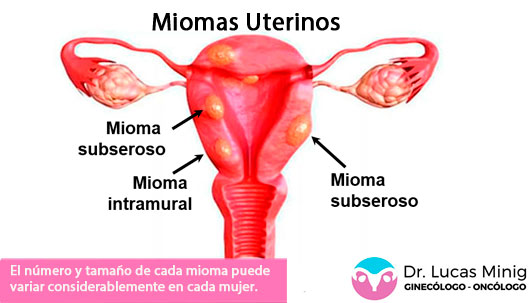 Cirugía Miomas en el útero. Intramurales, subsesoros.
