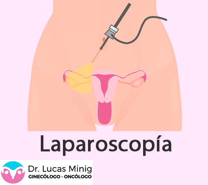 cirugía-miomectomia-laparoscópica
