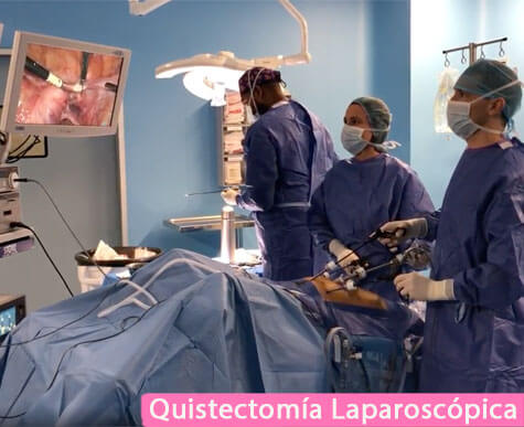 Cirugía Quistectomía Laparoscópica. Operación de Quises ováricos