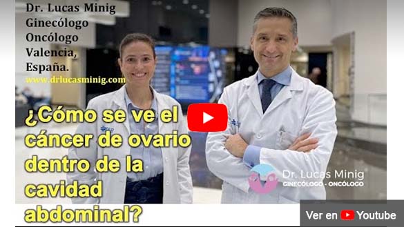 ¿Cómo se ve el cáncer de ovario dentro de la cavidad abdominal? Dr. Lucas Minig