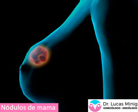 Detectar Nódulos en la mama (Ginecólogo Oncólogo especialista)