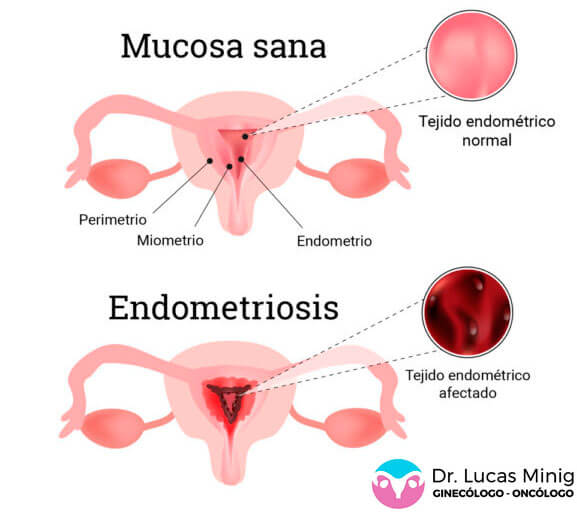 Tejido Endométrico Afectado por endometriosis