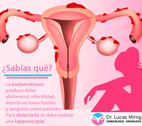 La endometriosis produce Dolor abdominal, infertilidad, sintomas de enfermedad