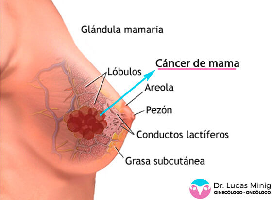 Cáncer de mama especialista en Valencia España Dr. Lucas Minig