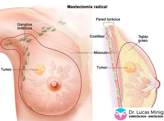 Mastectomía Extirpación glandula mamaria. Cirugía Cáncer de mama
