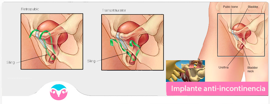 Implante Anti-incontinencia Dr Lucas Minig
