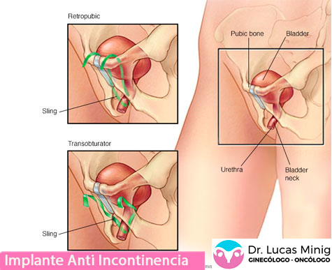 Usar implante para controlar incontinencia urinaria