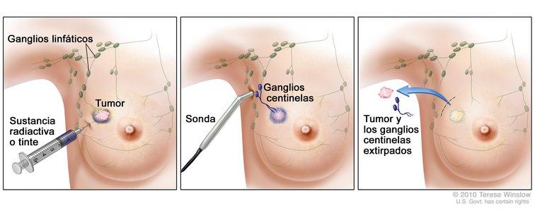 Linfadenectomía Axilar Operación cáncer de mama