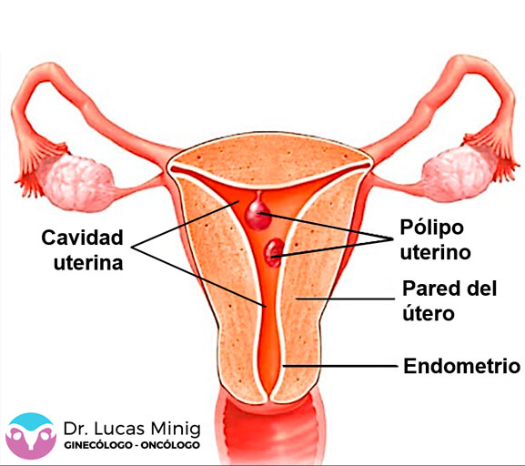 Especialistas en Pólipos endometriales Valencia, España.