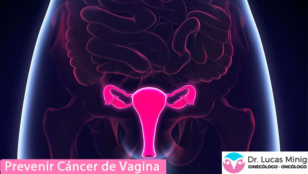 Prevenir cáncer de vagina. especialista Lucas Minig en Valencia España