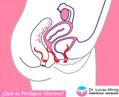 Qué es un prolapso uterino, donde tratarlo en España. Ginecólogo oncólogo especialista