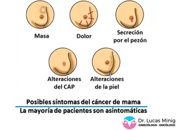 Síntomas del cáncer de seno. (cáncer mamario) España