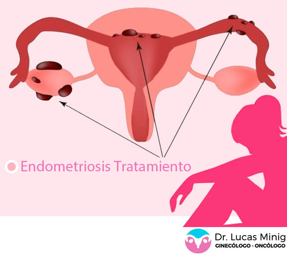 Endometriosis Tratamiento en España