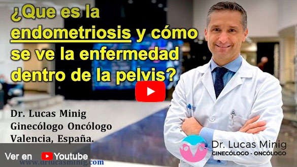 Tratamiento de Endometriosis en España